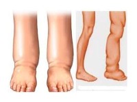 हात्तीपाइलेविरुद्धको दशदिने औषधि सेवन अभियान