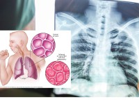 आज विश्व निमोनिया दिवसः रोकथाम र सशक्त स्वास्थ्य प्रणालीमा जोड