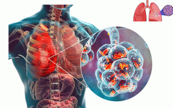 नवलपरासी पूर्वमा गण्डकी प्रदेशकै सबैभन्दा बढी क्षयरोगी