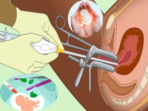 अझै रोकिएन असुरक्षित गर्भपतन : आफूखुसी औषधि नखाऔँ