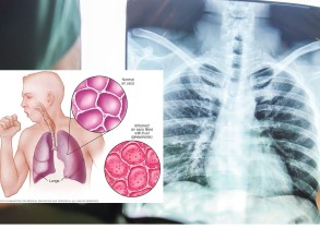 आज विश्व निमोनिया दिवसः रोकथाम र सशक्त स्वास्थ्य प्रणालीमा जोड