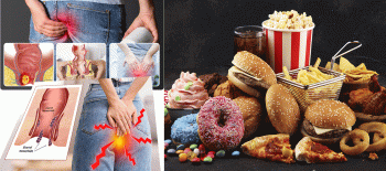 जीवनशैलीमा आएको परिवर्तनले पायल्स, फिस्टुला र फिसरका बिरामी बढ्दै