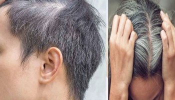 सेतो कपाल हुनु उमेर मात्र होइन,कारण के?