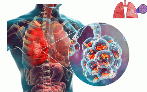सुदूरपश्चिममा क्षयरोगको समस्या बढ्दै
